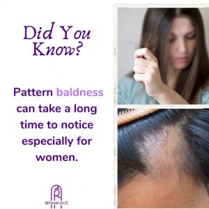 Pattern baldness can take a long time to notice especially for women.​